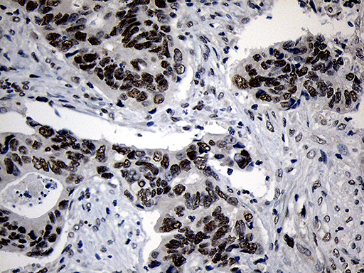 ZNF670 Antibody - Immunohistochemical staining of paraffin-embedded Adenocarcinoma of Human colon tissue using anti-ZNF670 mouse monoclonal antibody. (Heat-induced epitope retrieval by 1mM EDTA in 10mM Tris buffer. (pH8.5) at 120°C for 3 min. (1:500)