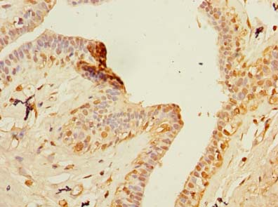 ZNF670 Antibody - Immunohistochemistry of paraffin-embedded human breast cancer using antibody at dilution of 1:100.