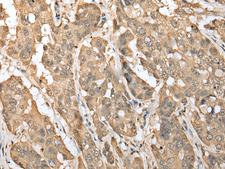 ZNF672 Antibody - Immunohistochemistry of paraffin-embedded Human breast cancer tissue  using ZNF672 Polyclonal Antibody at dilution of 1:30(×200)