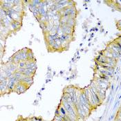 ZNF673 Antibody - Immunohistochemistry of paraffin-embedded Human colon carcinoma using KRBOX4 Polyclonal Antibody at dilution of 1:200 (40x lens).