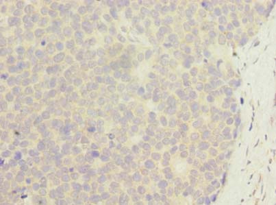 ZNF688 Antibody - Immunohistochemistry of paraffin-embedded human gastric cancer using antibody at dilution of 1:100.