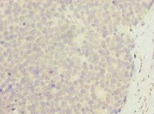ZNF688 Antibody - Immunohistochemistry of paraffin-embedded human gastric cancer using antibody at dilution of 1:100.