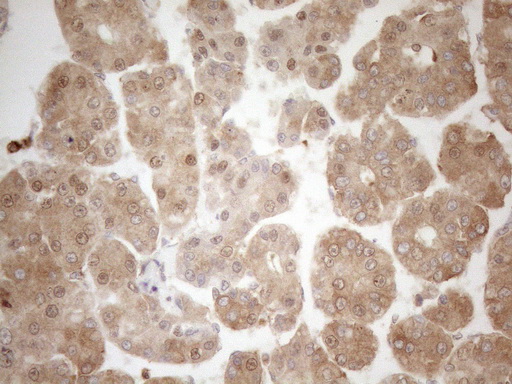 ZNF69 Antibody - Immunohistochemical staining of paraffin-embedded Carcinoma of Human liver tissue using anti-ZNF69 mouse monoclonal antibody. (Heat-induced epitope retrieval by 1mM EDTA in 10mM Tris buffer. (pH8.5) at 120°C for 3 min. (1:150)