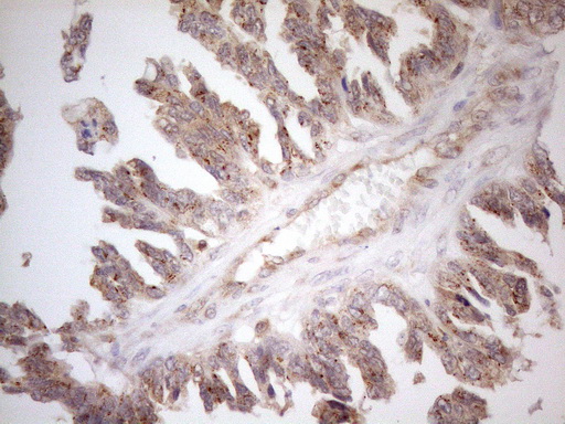 ZNF69 Antibody - Immunohistochemical staining of paraffin-embedded Adenocarcinoma of Human ovary tissue using anti-ZNF69 mouse monoclonal antibody. (Heat-induced epitope retrieval by 1mM EDTA in 10mM Tris buffer. (pH8.5) at 120°C for 3 min. (1:150)