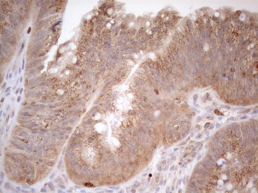ZNF69 Antibody - Immunohistochemical staining of paraffin-embedded Carcinoma of Human pancreas tissue using anti-ZNF69 mouse monoclonal antibody. (Heat-induced epitope retrieval by 1mM EDTA in 10mM Tris buffer. (pH8.5) at 120°C for 3 min. (1:150)
