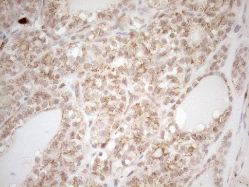 ZNF69 Antibody - Immunohistochemical staining of paraffin-embedded Human thyroid tissue using anti-ZNF69 mouse monoclonal antibody. (Heat-induced epitope retrieval by 1mM EDTA in 10mM Tris buffer. (pH8.5) at 120°C for 3 min. (1:150)