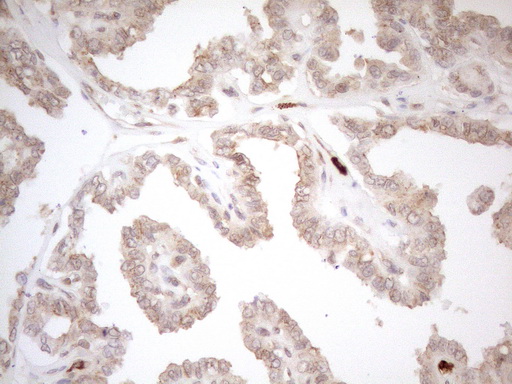 ZNF69 Antibody - Immunohistochemical staining of paraffin-embedded Carcinoma of Human thyroid tissue using anti-ZNF69 mouse monoclonal antibody. (Heat-induced epitope retrieval by 1mM EDTA in 10mM Tris buffer. (pH8.5) at 120°C for 3 min. (1:150)