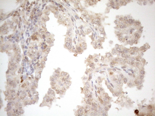 ZNF69 Antibody - Immunohistochemical staining of paraffin-embedded Adenocarcinoma of Human endometrium tissue using anti-ZNF69 mouse monoclonal antibody. (Heat-induced epitope retrieval by 1mM EDTA in 10mM Tris buffer. (pH8.5) at 120°C for 3 min. (1:150)