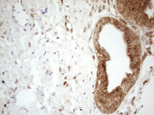 ZNF69 Antibody - Immunohistochemical staining of paraffin-embedded Carcinoma of Human prostate tissue using anti-ZNF69 mouse monoclonal antibody. (Heat-induced epitope retrieval by 1mM EDTA in 10mM Tris buffer. (pH8.5) at 120°C for 3 min. (1:150)