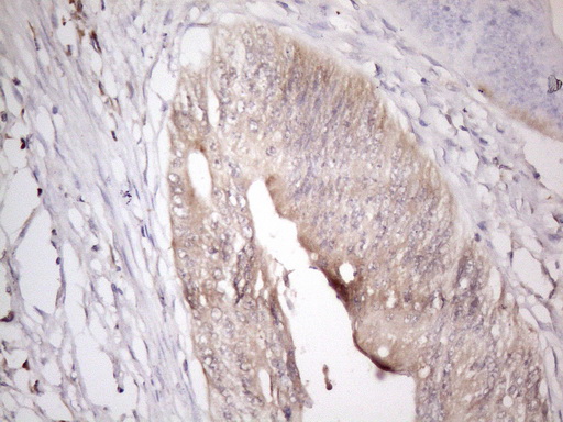 ZNF69 Antibody - Immunohistochemical staining of paraffin-embedded Adenocarcinoma of Human colon tissue using anti-ZNF69 mouse monoclonal antibody. (Heat-induced epitope retrieval by 1mM EDTA in 10mM Tris buffer. (pH8.5) at 120°C for 3 min. (1:150)
