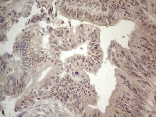 ZNF69 Antibody - Immunohistochemical staining of paraffin-embedded Adenocarcinoma of Human colon tissue using anti-ZNF69 mouse monoclonal antibody. (Heat-induced epitope retrieval by 1mM EDTA in 10mM Tris buffer. (pH8.5) at 120°C for 3 min. (1:150)