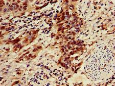 ZNF695 Antibody - Immunohistochemistry image of paraffin-embedded human bladder cancer at a dilution of 1:100
