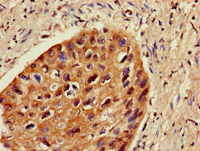 ZNF695 Antibody - Immunohistochemistry image of paraffin-embedded human cervical cancer at a dilution of 1:100