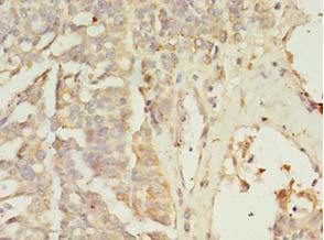 ZNF699 Antibody - Immunohistochemistry of paraffin-embedded human endometrial cancer tissue using antibody at 1:100 dilution.