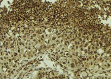 ZNF7 Antibody - 1:100 staining human breast carcinoma tissue by IHC-P. The sample was formaldehyde fixed and a heat mediated antigen retrieval step in citrate buffer was performed. The sample was then blocked and incubated with the antibody for 1.5 hours at 22°C. An HRP conjugated goat anti-rabbit antibody was used as the secondary.