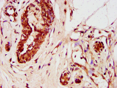 ZNF703 Antibody - Immunohistochemistry image at a dilution of 1:400 and staining in paraffin-embedded human breast cancer performed on a Leica BondTM system. After dewaxing and hydration, antigen retrieval was mediated by high pressure in a citrate buffer (pH 6.0) . Section was blocked with 10% normal goat serum 30min at RT. Then primary antibody (1% BSA) was incubated at 4 °C overnight. The primary is detected by a biotinylated secondary antibody and visualized using an HRP conjugated SP system.