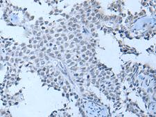 ZNF703 Antibody - Immunohistochemistry of paraffin-embedded Human ovarian cancer tissue  using ZNF703 Polyclonal Antibody at dilution of 1:55(×200)