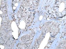 ZNF703 Antibody - Immunohistochemistry of paraffin-embedded Human colorectal cancer tissue  using ZNF703 Polyclonal Antibody at dilution of 1:40(×200)