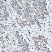 ZNF707 Antibody - Immunohistochemistry of paraffin-embedded Human lung cancer using ZNF707 Polyclonal Antibody at dilution of 1:100 (40x lens).