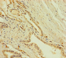 ZNF71 Antibody - Immunohistochemistry of paraffin-embedded human prostate cancer using ZNF71 Antibody at dilution of 1:100
