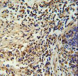 ZNF720 Antibody - ZNF720 Antibody immunohistochemistry of formalin-fixed and paraffin-embedded human lung carcinoma followed by peroxidase-conjugated secondary antibody and DAB staining.