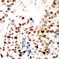 ZNF75 / ZNF75D Antibody - Immunohistochemical analysis of ZNF75D staining in human breast cancer formalin fixed paraffin embedded tissue section. The section was pre-treated using heat mediated antigen retrieval with sodium citrate buffer (pH 6.0). The section was then incubated with the antibody at room temperature and detected using an HRP conjugated compact polymer system. DAB was used as the chromogen. The section was then counterstained with hematoxylin and mounted with DPX.