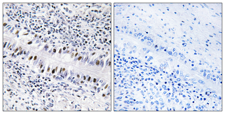 ZNF76 Antibody - Immunohistochemistry analysis of paraffin-embedded human lung carcinoma, using ZNF76 Antibody. The picture on the right is blocked with the synthesized peptide.