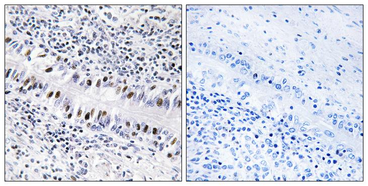 ZNF76 Antibody - Peptide - + Immunohistochemistry analysis of paraffin-embedded human lung carcinoma tissue, using ZNF76 antibody.