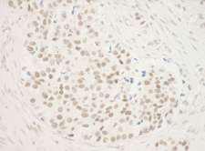 ZNF768 Antibody - Detection of Human ZNF768 by Immunohistochemistry. Sample: FFPE section of human breast carcinoma. Antibody: Affinity purified rabbit anti-ZNF768 used at a dilution of 1:250.