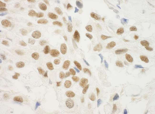 ZNF768 Antibody - Detection of Human ZNF768 by Immunohistochemistry. Sample: FFPE section of human breast carcinoma. Antibody: Affinity purified rabbit anti-ZNF768 used at a dilution of 1:200 (1 ug/ml). Detection: DAB.