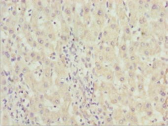 ZNF785 Antibody - Immunohistochemistry of paraffin-embedded human liver cancer at dilution 1:100
