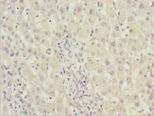 ZNF785 Antibody - Immunohistochemistry of paraffin-embedded human liver cancer at dilution 1:100
