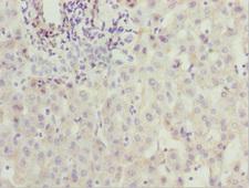 ZNF785 Antibody - Immunohistochemistry of paraffin-embedded human liver cancer at dilution 1:100