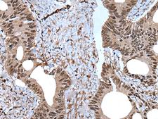 ZNF787 Antibody - Immunohistochemistry of paraffin-embedded Human colorectal cancer tissue  using ZNF787 Polyclonal Antibody at dilution of 1:45(×200)