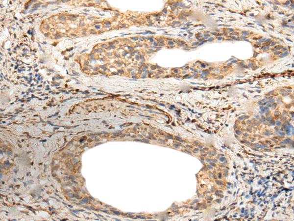 ZNF8 Antibody - Immunohistochemistry of paraffin-embedded Human cervical cancer tissue  using ZNF8 Polyclonal Antibody at dilution of 1:40(×200)