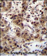 ZNF816 / ZNF816A Antibody - ZNF321 Antibody (N-term) immunohistochemistry analysis in formalin fixed and paraffin embedded human breast carcinoma followed by peroxidase conjugation of the secondary antibody and DAB staining.This data demonstrates the use of ZNF321 Antibody (N-term) for immunohistochemistry. Clinical relevance has not been evaluated.