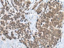ZNF83 / HPF1 Antibody - Immunohistochemistry of paraffin-embedded Human thyroid cancer tissue  using ZNF83 Polyclonal Antibody at dilution of 1:50(×200)