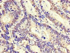 ZNF844 Antibody - Immunohistochemistry of paraffin-embedded human colon cancer using ZNF844 Antibody at dilution of 1:100