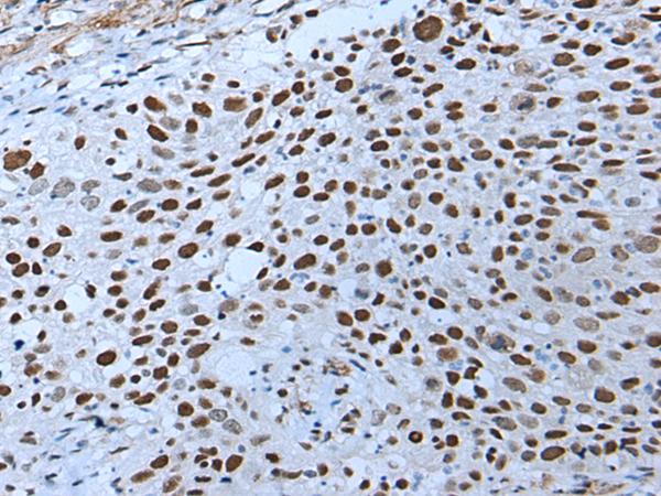 ZNHIT3 Antibody - Immunohistochemistry of paraffin-embedded Human lung cancer tissue  using ZNHIT3 Polyclonal Antibody at dilution of 1:80(×200)