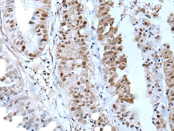 ZNHIT3 Antibody - Immunohistochemistry of paraffin-embedded Human liver cancer tissue  using ZNHIT3 Polyclonal Antibody at dilution of 1:80(×200)