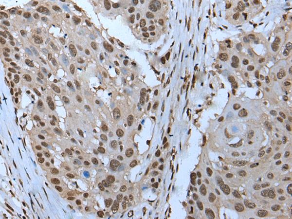 ZNHIT3 Antibody - Immunohistochemistry of paraffin-embedded Human esophagus cancer tissue  using ZNHIT3 Polyclonal Antibody at dilution of 1:95(×200)