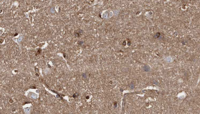 ZNRF1 Antibody - 1:100 staining human brain carcinoma tissue by IHC-P. The sample was formaldehyde fixed and a heat mediated antigen retrieval step in citrate buffer was performed. The sample was then blocked and incubated with the antibody for 1.5 hours at 22°C. An HRP conjugated goat anti-rabbit antibody was used as the secondary.