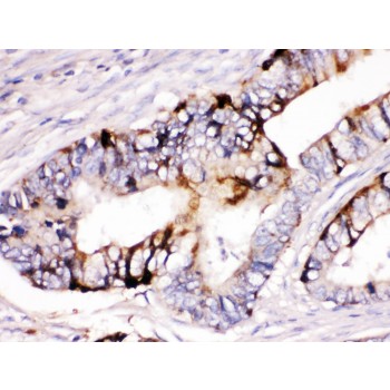 ZP2 Antibody - ZP2 was detected in paraffin-embedded sections of human intestinal cancer tissues using rabbit anti- ZP2 Antigen Affinity purified polyclonal antibody at 1 ug/mL. The immunohistochemical section was developed using SABC method.