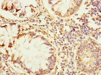 ZP2 Antibody - Immunohistochemistry of paraffin-embedded human colon cancer at dilution 1:100