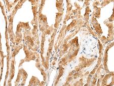 ZPBP / SP38 Antibody - Immunohistochemistry of paraffin-embedded Human thyroid cancer tissue  using ZPBP Polyclonal Antibody at dilution of 1:30(×200)