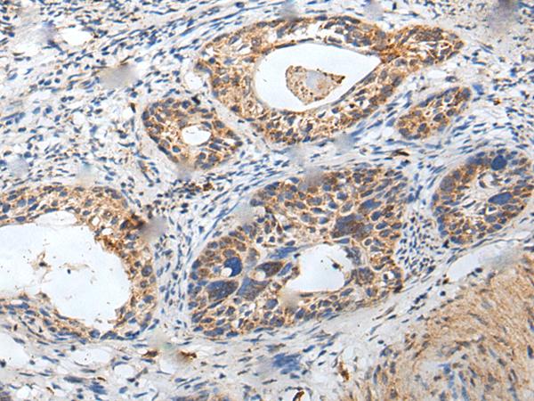 ZPBP / SP38 Antibody - Immunohistochemistry of paraffin-embedded Human cervical cancer tissue  using ZPBP Polyclonal Antibody at dilution of 1:30(×200)