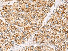 ZPBP2 Antibody - Immunohistochemistry of paraffin-embedded Human liver cancer tissue  using ZPBP2 Polyclonal Antibody at dilution of 1:50(×200)