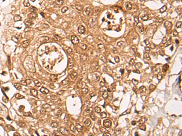 ZPR1 / ZNF259 Antibody - Immunohistochemistry of paraffin-embedded Human prost ate cancer tissue  using ZPR1 Polyclonal Antibody at dilution of 1:40(×200)