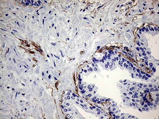 ZRANB1 / TRABID Antibody - Immunohistochemical staining of paraffin-embedded Carcinoma of Human prostate tissue using anti-ZRANB1 mouse monoclonal antibody. (Heat-induced epitope retrieval by 1mM EDTA in 10mM Tris buffer. (pH8.5) at 120°C for 3 min. (1:2000)