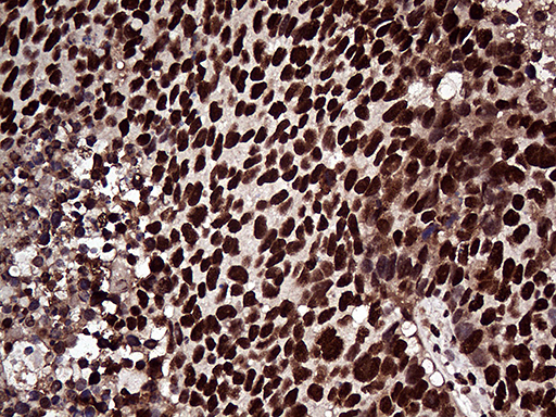 ZRANB2 / ZNF265 Antibody - Immunohistochemical staining of paraffin-embedded Carcinoma of Human lung tissue using anti-ZRANB2 mouse monoclonal antibody. (Heat-induced epitope retrieval by 1mM EDTA in 10mM Tris buffer. (pH8.5) at 120°C for 3 min. (1:2000)